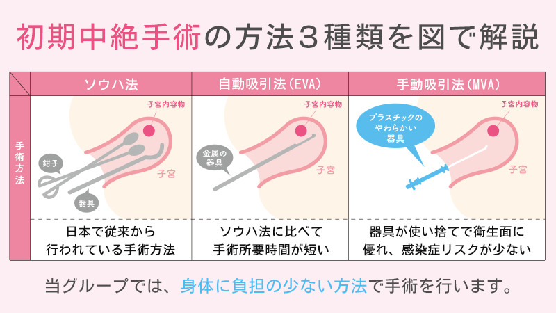 初期中絶手術の方法３種類を図で解説（ソウハ法・EVA・MVA）
